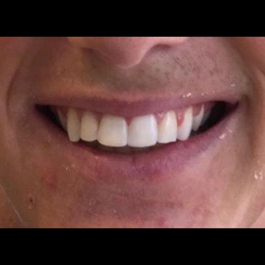 How 6 Month Braces Work - 6 month braces - after - 3Dental
